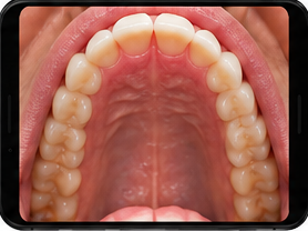 Phone tilted up to show upper teeth